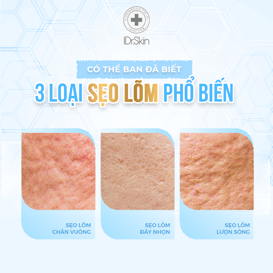 3-loai-seo-lom-pho-bien