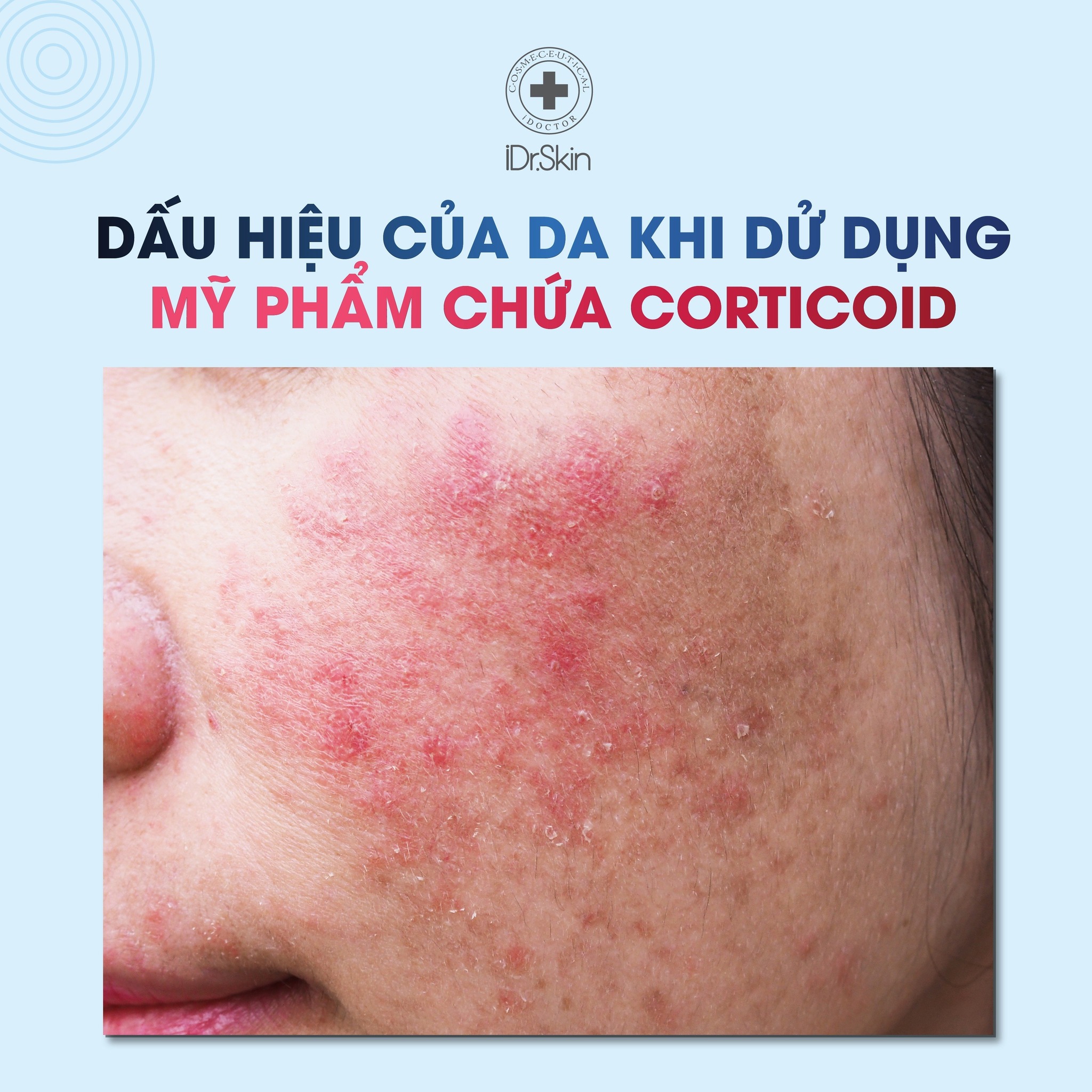 phuc-hoi-da-nhiem-corticoid-idrskin-2