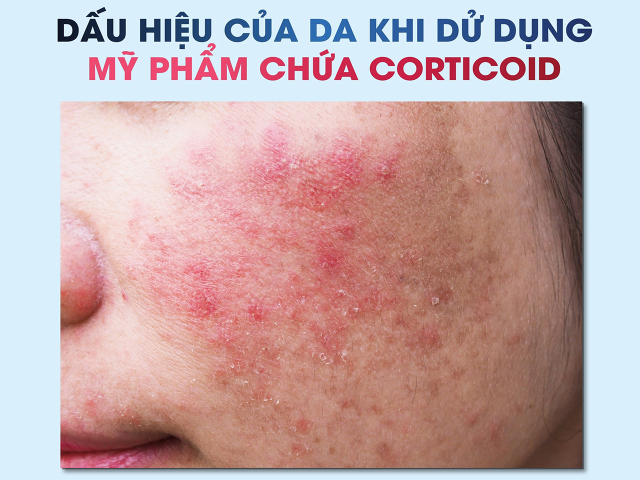 DA NHIỄM CORTICOID LÀ GÌ? PHỤC HỒI DA NHIỄM CORTICOID